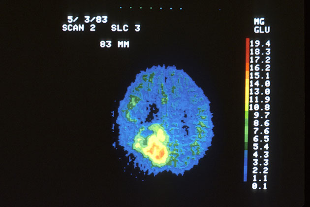 PET Scan of Brain Tumor