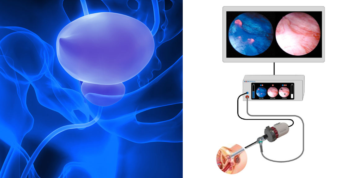Game-Changing Potential in Bladder Cancer Detection and Surgery