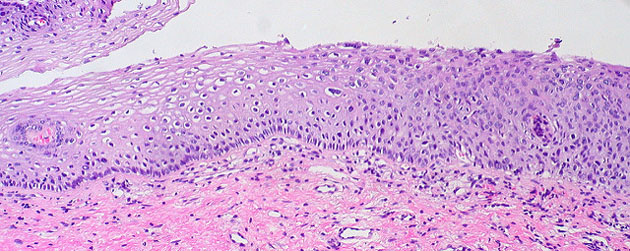 Spectrum of SIL/Cervical Dysplasia