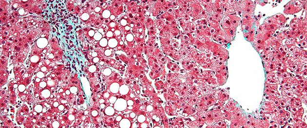 Periportal steatosis of the liver