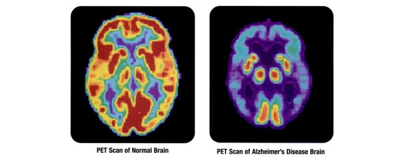 PET Scan