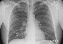 Chest X-ray